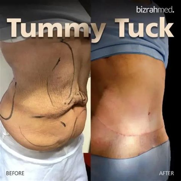 Bianca Censory Tummy Tuck: A Comprehensive Guide to Transforming Your Body
