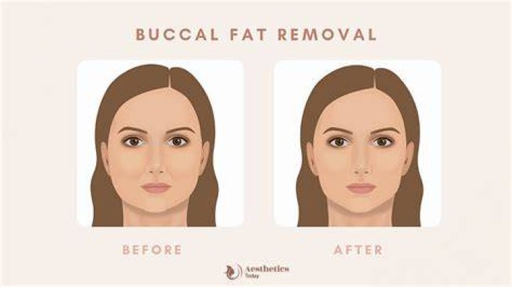 Celebrity Buccal Fat Removal: The Ultimate Guide to Achieving a Slimmer Face