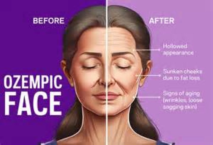 Pics of Ozempic Face: A Comprehensive Guide to Understanding and Addressing the Phenomenon